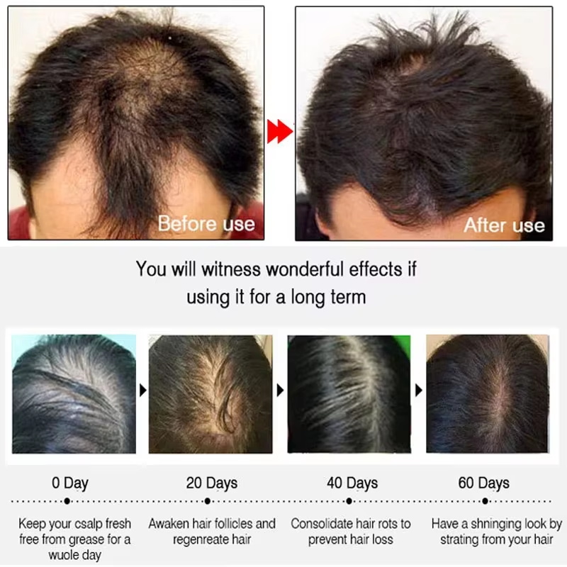 สเปรย์เร่งผมยาวขึ้นอย่างรวดเร็ - Hair Care Hair Serum บทวิจารณ์และราคา